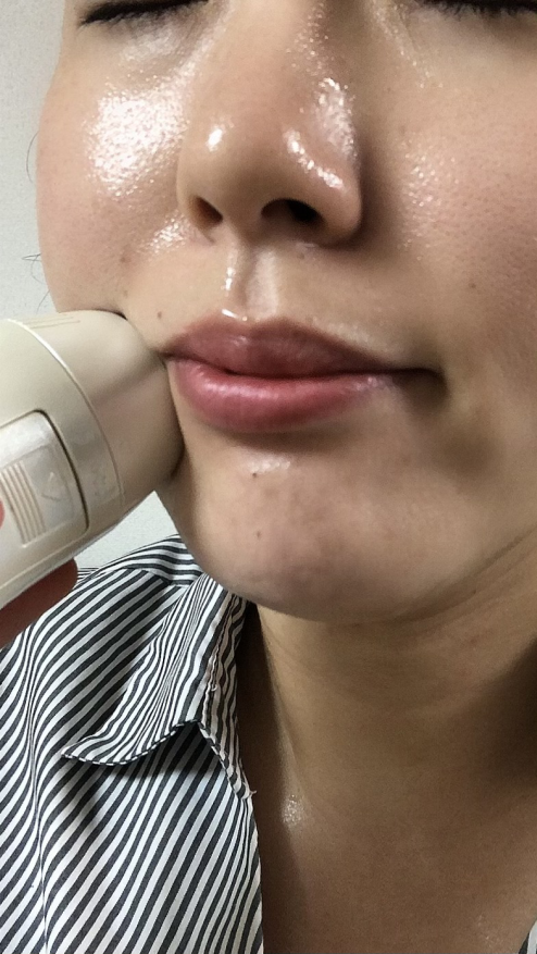 メディポレーションミニ体験レビュー