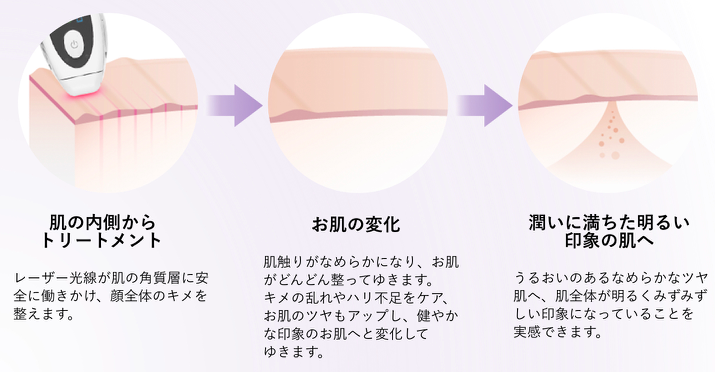 トリア 美容レーザー