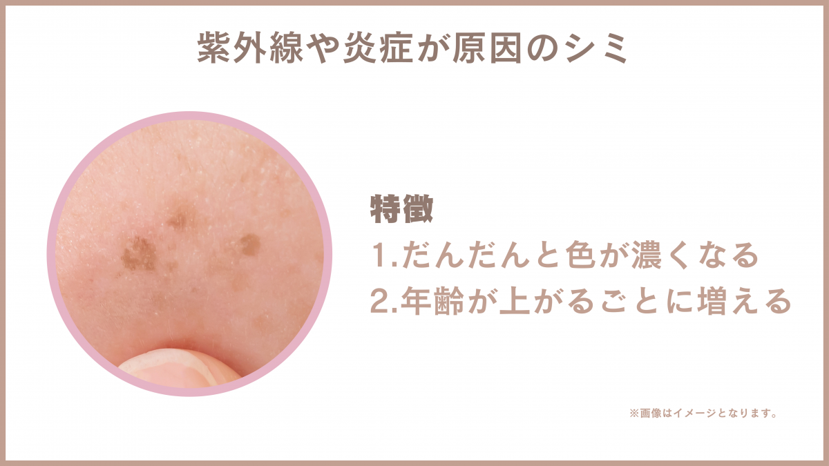 紫外線や炎症が原因のシミ