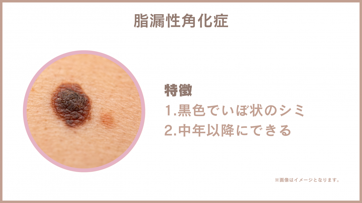 脂漏性角化症