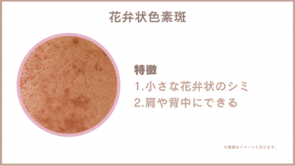花弁状色素斑