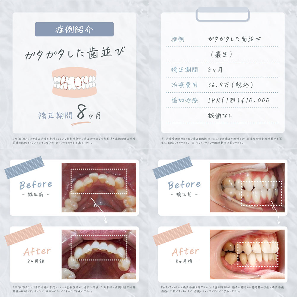 大人の歯科矯正の費用や相場は かかる期間で値段は変わる Laurier Beauty ローリエビューティー 大人の歯科矯正の費用や相場は かかる期間で値段は変わる Laurier Beauty ローリエビューティー