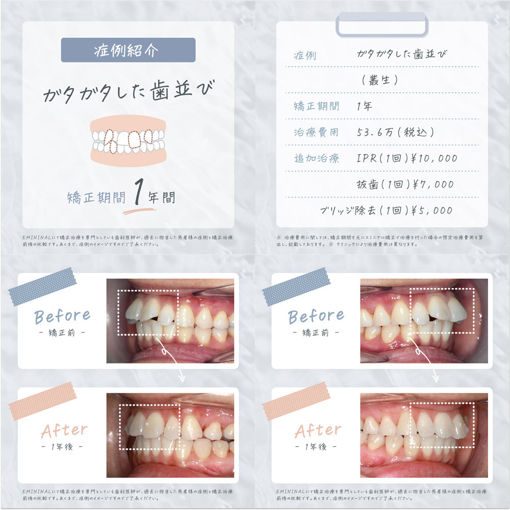 大人の歯科矯正の費用や相場は かかる期間で値段は変わる Laurier Beauty ローリエビューティー 大人の歯科矯正の費用や相場は かかる期間で値段は変わる Laurier Beauty ローリエビューティー